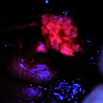 Fluorescent Guided Brain Surgery