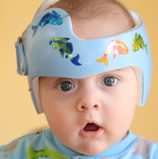 Infant wearing a helmet for therapy, also known as cranial remolding therapy