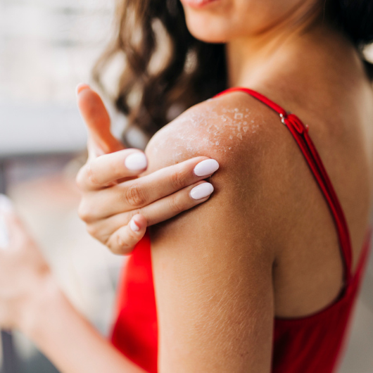 A brunette woman looks at her shoulder to see her sunburn.