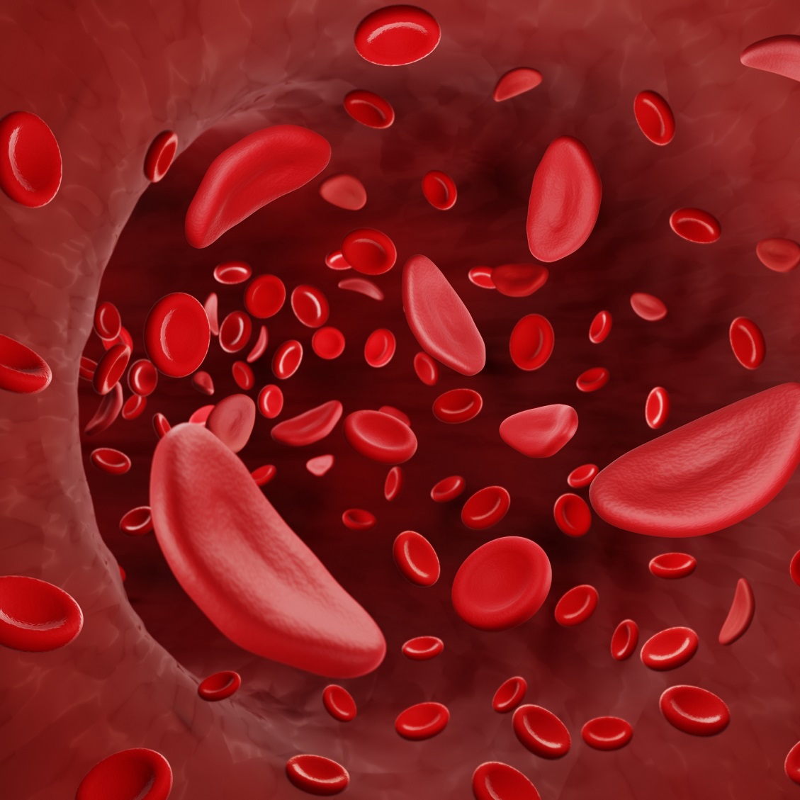 New Curative Treatment for Sickle Cell Disease