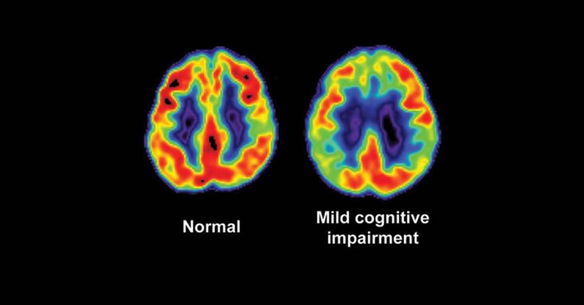 Atrial Fibrillation and Dementia