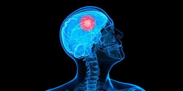 Brain Cancer Treatment