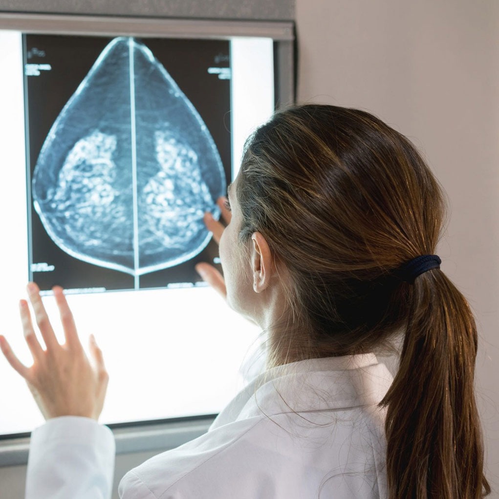 Doctor looking at dense breast mammogram