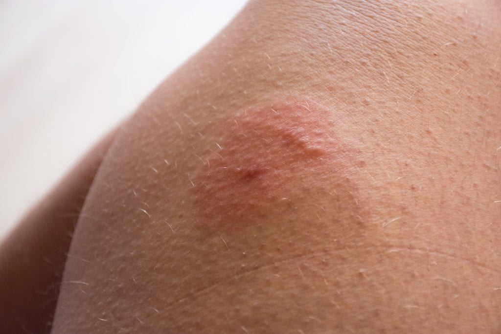 horsefly bite
