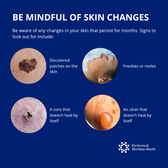 Graphic sharing skin changes to be mindful of including discoloration, freckles of moles, sores that don't heal, or ulcers that don't heal.