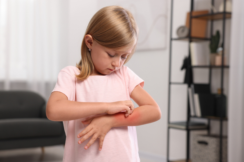 Food Allergy Rash: What Does It Look Like?