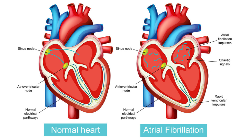 Detailed vector illustration contrasting normal heart function with atrial fibrillation, highlighting electrical pathways and nodes.